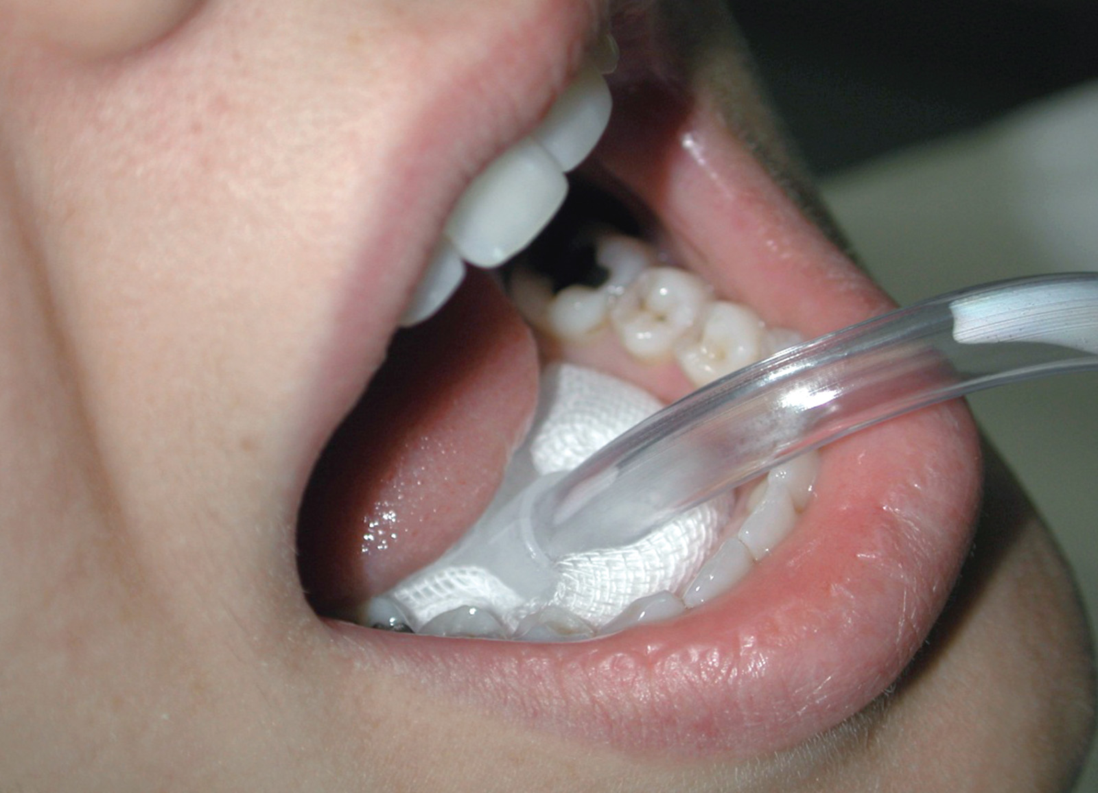 Specchietto Dentista, Specchio Dentista | 1.5x Funzione di Ingrandimento ​|  Aspetto del Dente Unico e Interessante - Cure Odontoiatriche Specchio