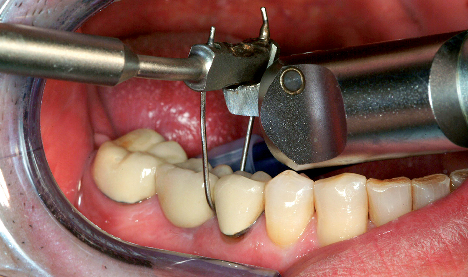 il 9 migliori cemento dentale: Guida PROFESSIONALE del 2024 