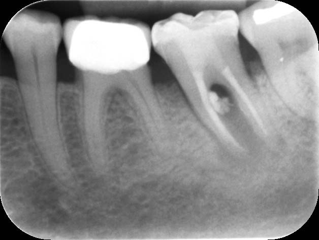 Riempimento dei denti con cemento temporaneo per il trattamento del canale  radicolare. Rimozione dei nervi dentali, preparazione per protesi Foto  stock - Alamy