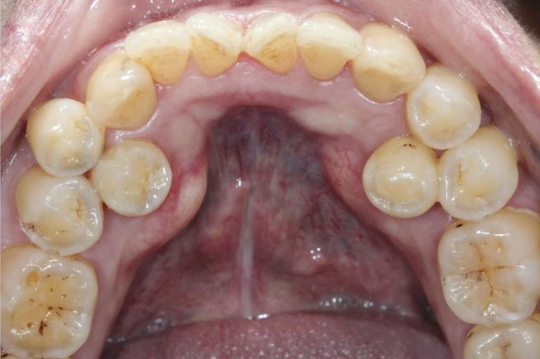 Denti sovrannumerari
