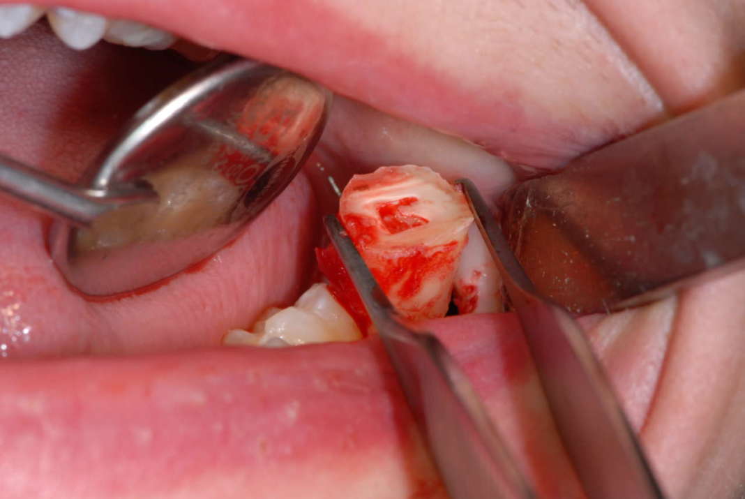 piezoelettrico estrazione terzo molare